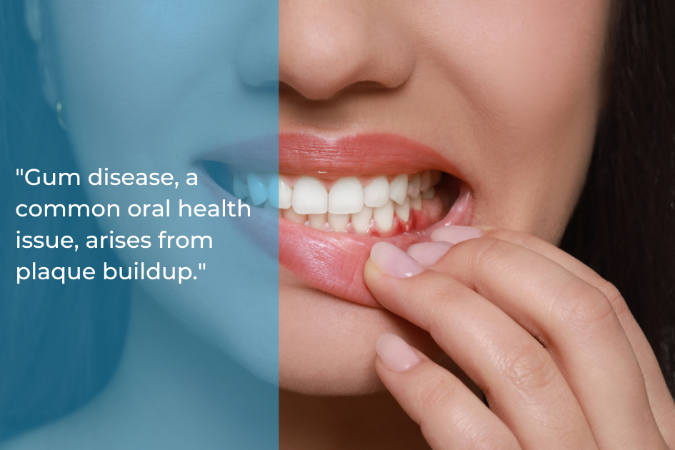 Close-up of a person touching their gums, with text: "Gum disease, a common oral health issue linked to heart disease, arises from plaque buildup.